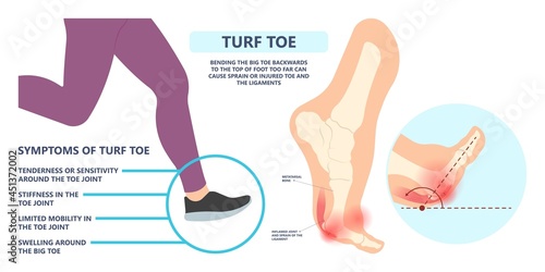 turf toe gout torn tear broken bone big joint sprain sport foot distal pain trauma range of motion bend ankle tendon ball lesser flexor brevis plate bent treat first Aid heal Inflamed deformity stiff