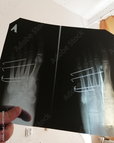 orthopedic surgery of human foot on x-ray. pin osteosynthesis photo