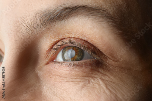 Closeup view of mature woman with cataract photo