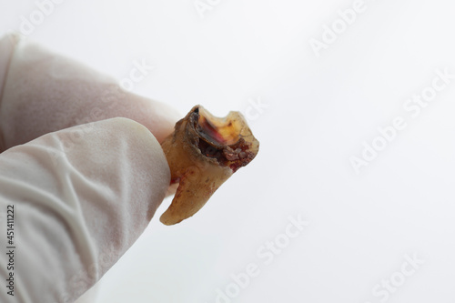 Doctor holding tooth decay extracted from the patient s mouth