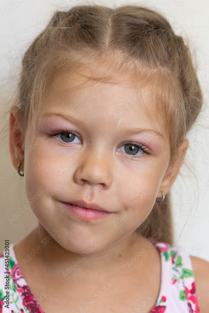 Portrait of caucasian little girl of five years old with swelling eyes because of allergy, conjunctevitis and adenoids Portrait of caucasian little girl of five years old with swelling eyes because of allergy, conjunctevitis and adenoids