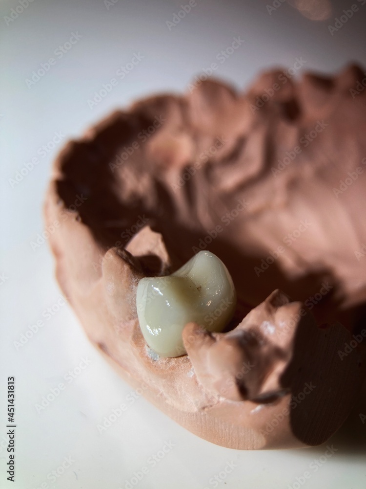 Tooth for dental crown placement.