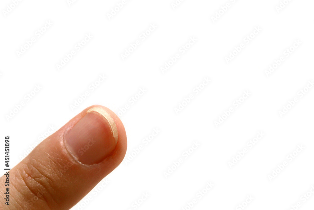 Close-up of a man's finger with a problematic nail Close-up of a man's finger with a problematic nail