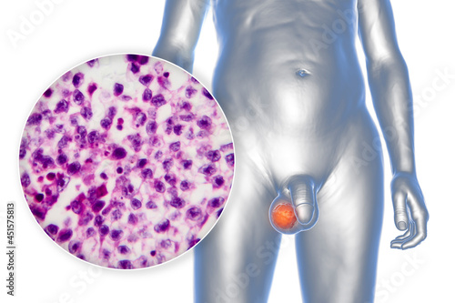Fotografía Testicular cancer, 3D illustration