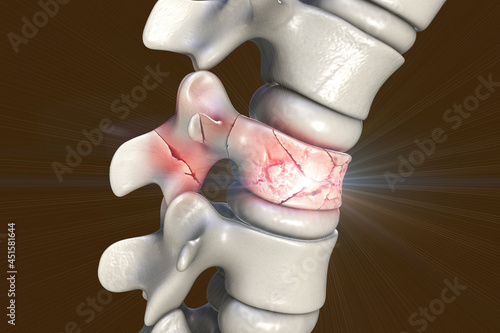 Obraz na plátně Spinal fracture, traumatic vertebral injury, illustration