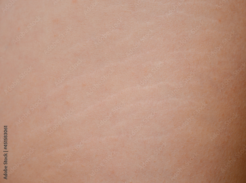 Detailed view of stretch marks on the thigh and the texture of human skin. Detailed view of stretch marks on the thigh and the texture of human skin.