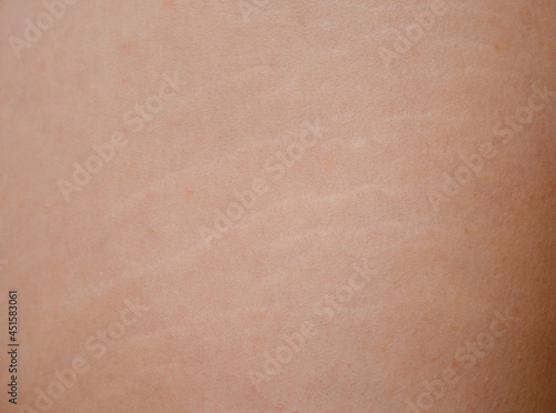 Detailed view of stretch marks on the thigh and the texture of human skin.
