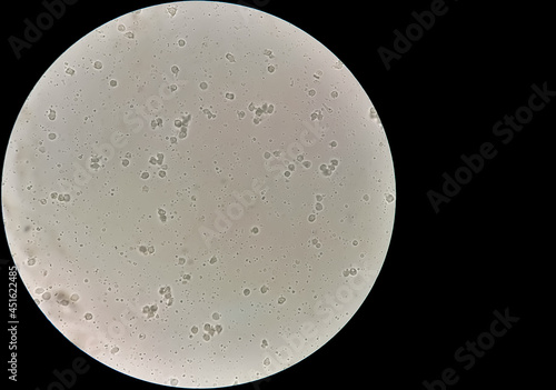 Sperm or semen test or analysis. Azoospermia with plenty pus cells seen. infertily. no sperm photo