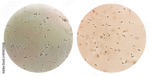 Sperm or semen test or analysis concept photo. Two collage of microphotograph, one is showing Azoospermia with plenty pus cells another Normospermia photo
