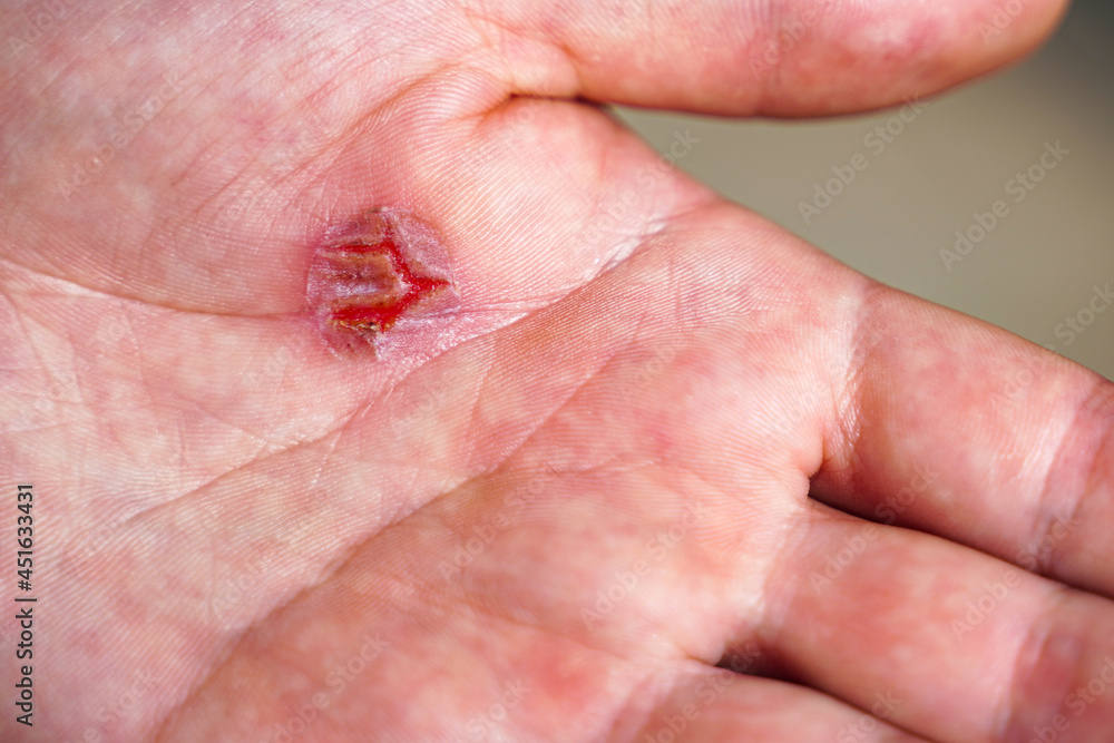 Fototapeta premium Close-up of callus on human hand, rubbing on skin close-up. Skin problems. Palm with Calluses. Hard Work Concept. Blisters on the Injured Hand