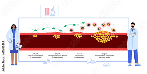 esophageal cancer stages