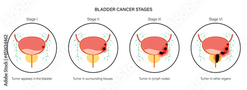 Bladder cancer stages