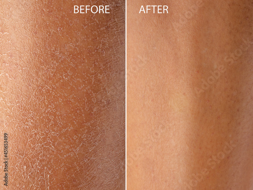 Quadro su tela Dry skin before and after moisturizing treatment