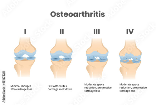 Osteoarthritis four stages anatomical and scientific illustration