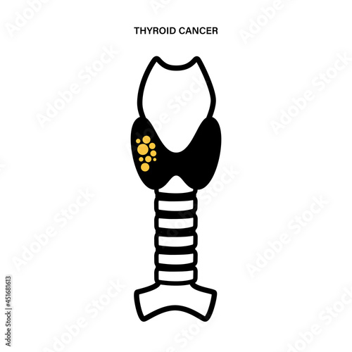 Thyroid cancer stages