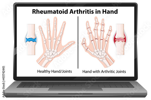 Rheumatoid arthritis symptoms on hand on laptop screen
