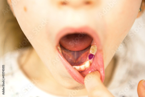 Colored purple filling on the girl s milk chewing tooth. Pediatric dentistry  treatment and examination. A child with an open mouth shows a tooth in close-up on a white background.