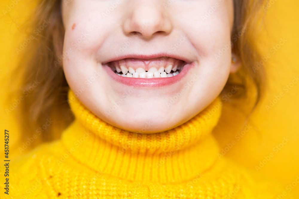 Girl shows her teeth-pathological bite, malocclusion, overbite ...