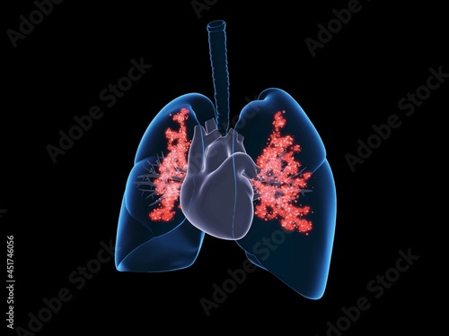 Viral lung infection, illustration photo