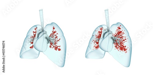 Viral lung infection, illustration photo