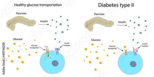 Diabetes type 2 and healthy glucose metabolism, illustration photo