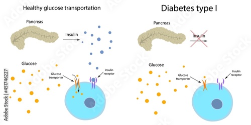 Diabetes type 1 and healthy glucose metabolism, illustration photo