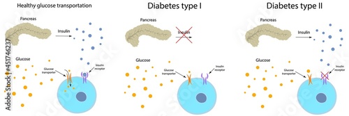 Diabetes and healthy glucose metabolism, illustration photo