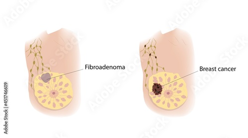 Fibroadenoma and breast cancer, illustration photo