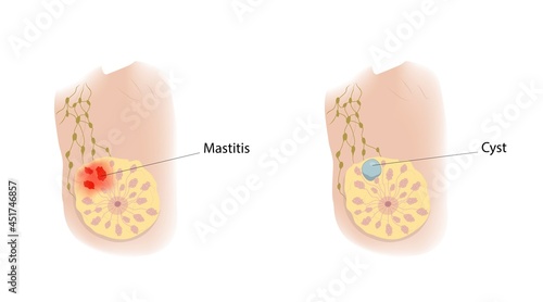 Mastitis and cyst, illustration photo