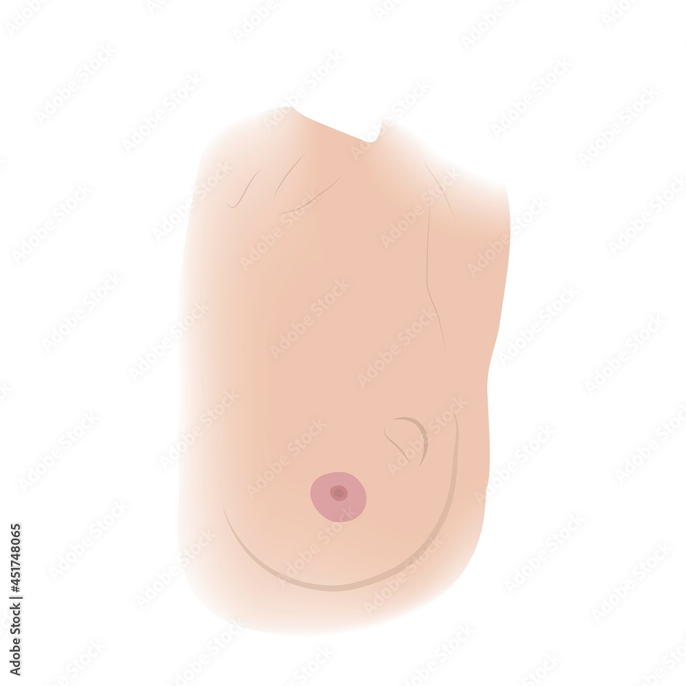 Breast lump, illustration Breast lump, illustration