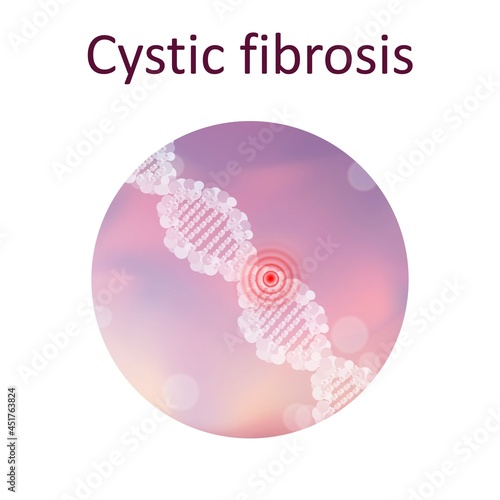 Cystic fibrosis, illustration photo