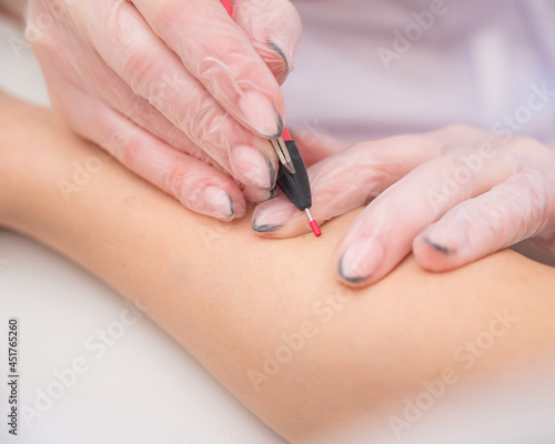 The doctor makes electro epilation of the woman's hands in the salon. Close-up of hardware removal of unwanted hair forever