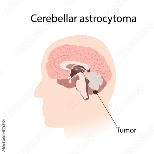 Cerebellar astrocytoma, illustration photo