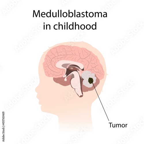 Medulloblastoma in childhood, illustration photo