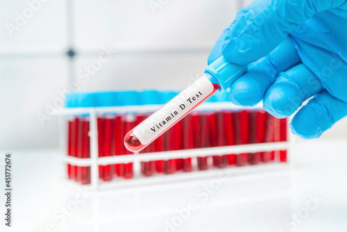 Vitamin D blood test, conceptual image photo