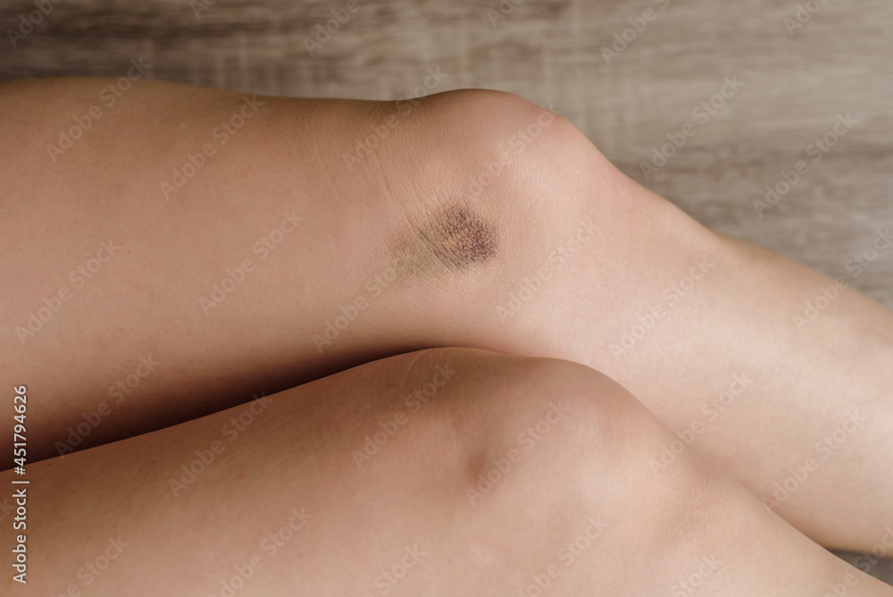 Closeup photo of large painful bruise on woman's leg