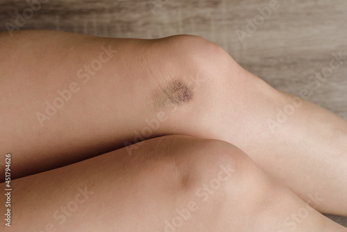 Closeup photo of large painful bruise on woman s leg