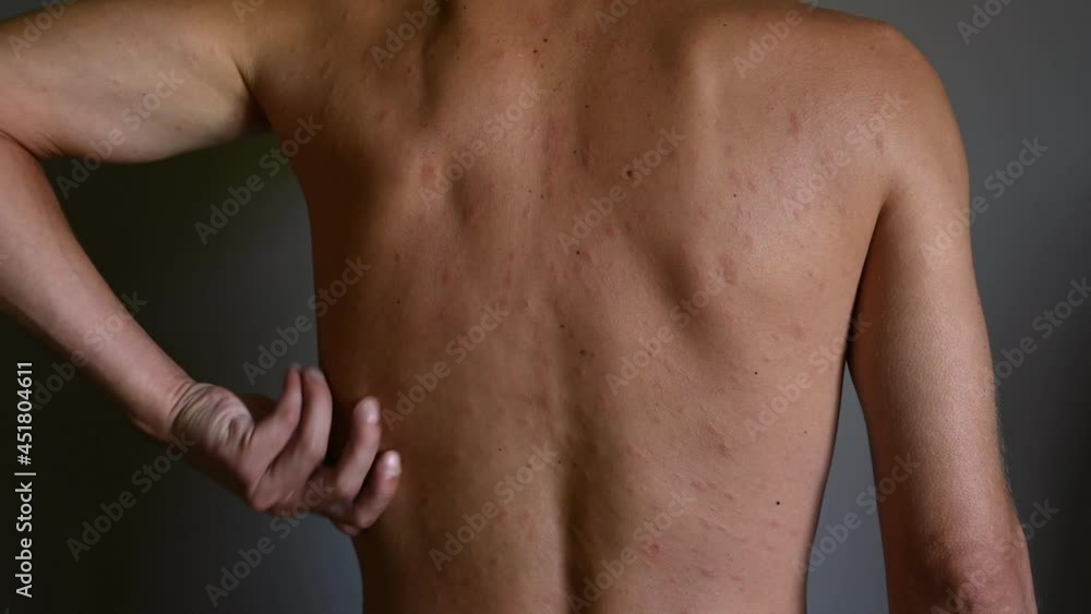 Rash on the body, red eruptions from measles or chickenpox. Infectious Diseases and Treatment. Rash on the body, red eruptions from measles or chickenpox. Infectious Diseases and Treatment.
