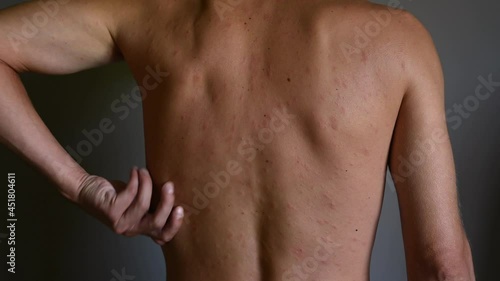 Rash on the body, red eruptions from measles or chickenpox. Infectious Diseases and Treatment. 