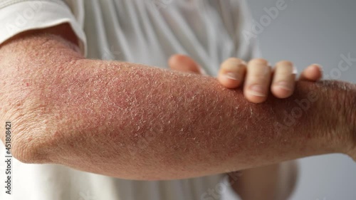 Extreme closeup of woman showing dry scaly skin rash hives on her arm Shown on white background.