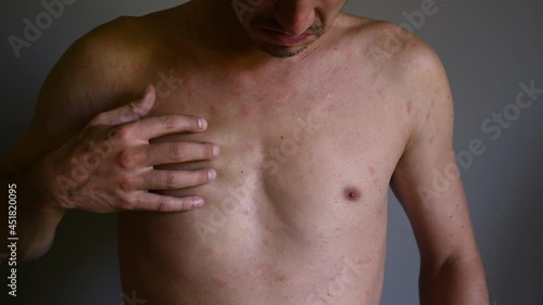 Rash on the body, red eruptions from measles or chickenpox. Infectious Diseases and Treatment. 