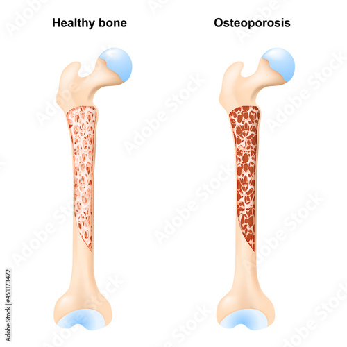 bone, and Osteoporosis