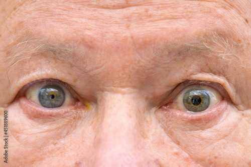Senior man with anisocoria showing unequal dilation of his pupil