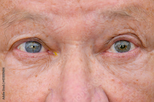 Foto Eyes of a senior man showing unequal pupil dilation