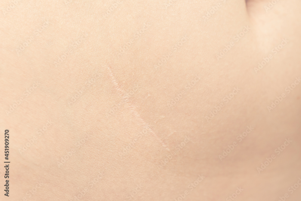 beautiful scar after appendectomy. scar on the skin after surgery. beautiful scar after appendectomy. scar on the skin after surgery.