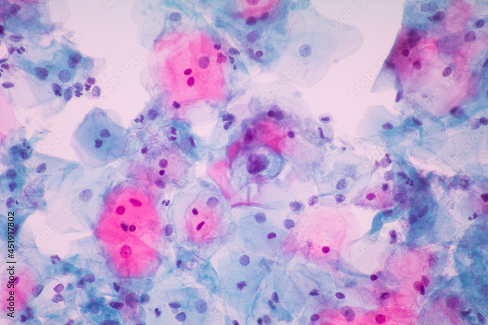 View in microscopic of Abnormal human cervix cells.Squamous epithelium