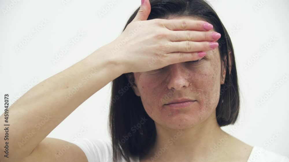 4k close up slowmotion video of woman with skin problems and moving her hand. 4k close up slowmotion video of woman with skin problems and moving her hand.