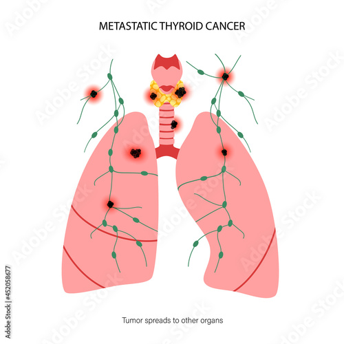 Thyroid cancer stages