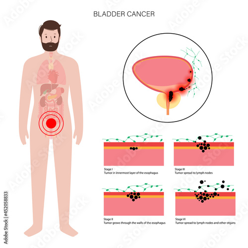 Bladder cancer stages photo