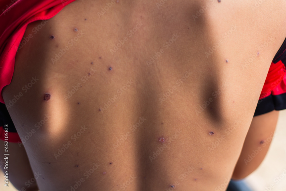scars from chicken pox, scar on boy back scars from chicken pox, scar on boy back